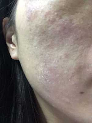 脸上起干壳怎么办（脸上起干壳怎么办很痒）