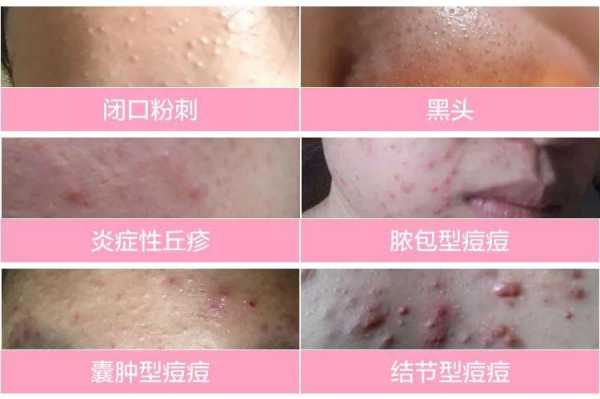 鹤叔闭口粉刺去除步骤,怎么祛粉刺啊女生