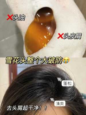 怎么去头皮屑,怎么去头皮削屑