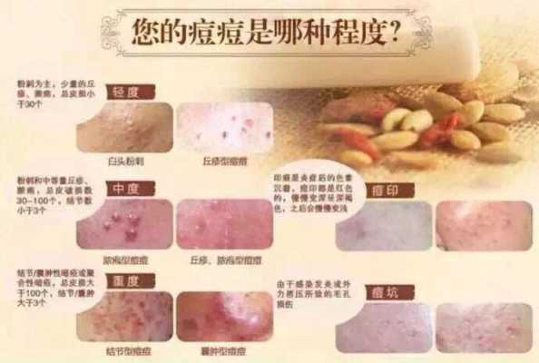 身上的痘痘怎么消除最快,怎么去痘痘快速方法