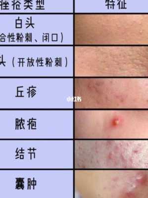 身上的痘痘怎么消除最快,怎么去痘痘快速方法