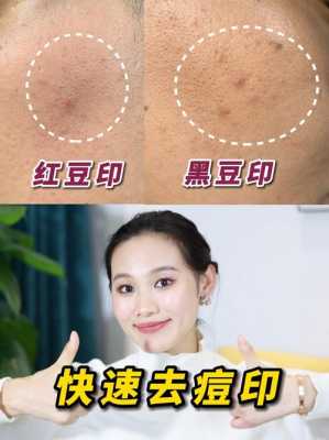 怎么去去痘印（怎么样去痘印）