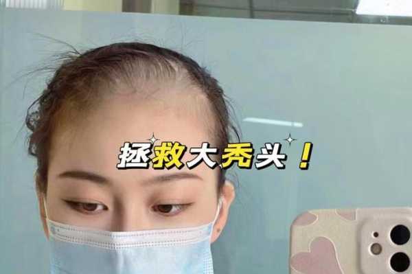 头皮太多怎么治（头上老是长一些小短发碎发特别是额头发际线那里很多小短发该怎么办？这个问题一直困扰我）