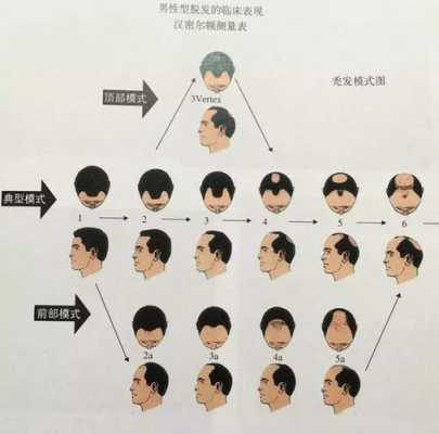 怎么判断脱发的类型（掉头发应该怎么办）