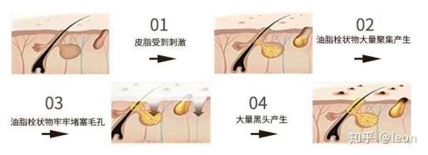 怎么样祛毛孔（怎么样祛毛孔黑头）