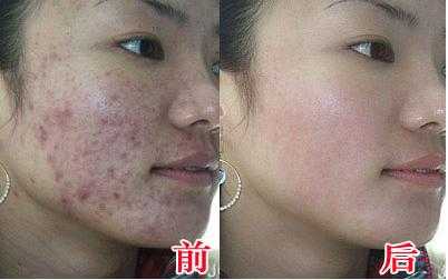 脸上长粉刺怎么去掉（脸上长粉刺怎么去掉?）