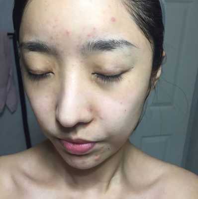 脸上长粉刺怎么去掉（脸上长粉刺怎么去掉?）