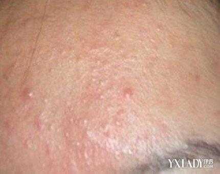 脸上长粉刺怎么去掉（脸上长粉刺怎么去掉?）