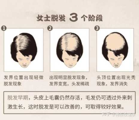 脱发主要的原因有哪些,怎么会导致脱发?