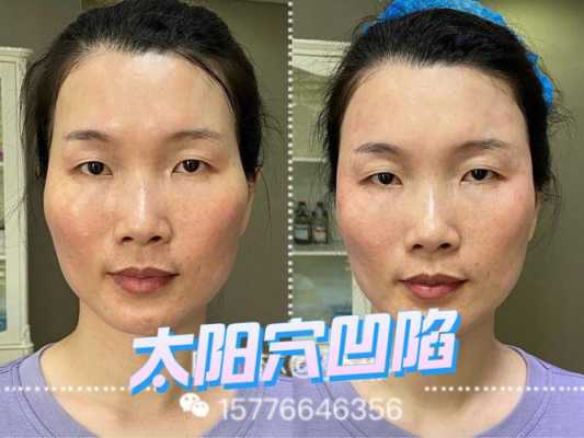 额骨大怎么办（额骨大怎么改善）