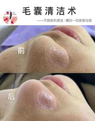 脸毛孔堵塞怎么清洁（毛孔有油脂粒怎么疏通）