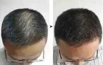 头顶稀疏能恢复浓密吗,头顶稀疏怎么变浓密