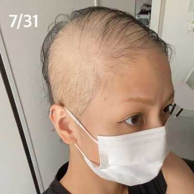 女的秃头叫什么,女人为什么会秃顶的原因