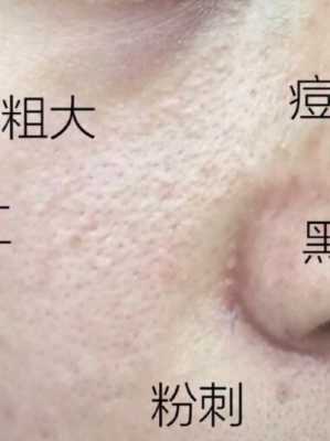 黑头毛孔粗大怎么治（黑头毛孔粗大怎么治）