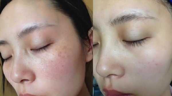 脸上色斑怎么淡斑,脸上有色斑怎么办?