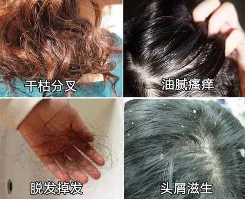 洗发掉发怎么办（洗发时掉发严重怎么办）