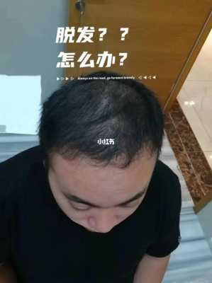 头发好掉怎么办（脱发掉发很严重应该怎么办呢）