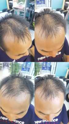 男士脱发是怎么回事（男士脱发是怎么回事呢）