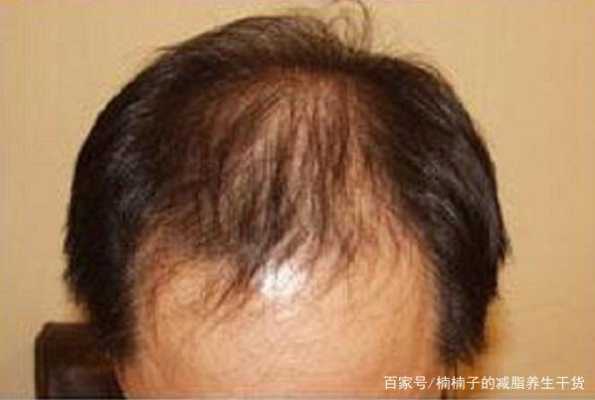 男士脱发是怎么回事（男士脱发是怎么回事呢）