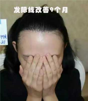 女生秃鬓角怎么办（女生秃鬓角怎么办还能长出来吗）