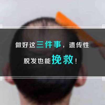 怎么预防遗传性脱发（怎么预防遗传性脱发）