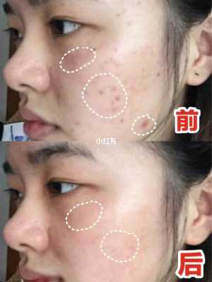 什么方法去痘印快速（脸上痘印祛除最快方法）