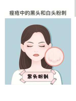 满脸黑头粉刺怎么办（黑头粉刺怎么解决）