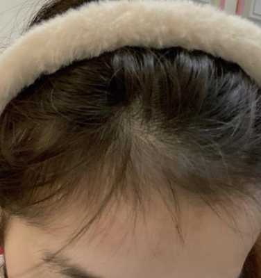额头长头发怎么回事（额头中间有个尖尖长出一点头发代表什么意思）