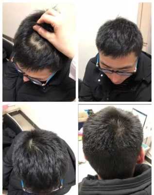 男人头发稀少，怎么变浓密,男生头发少怎么变浓密了