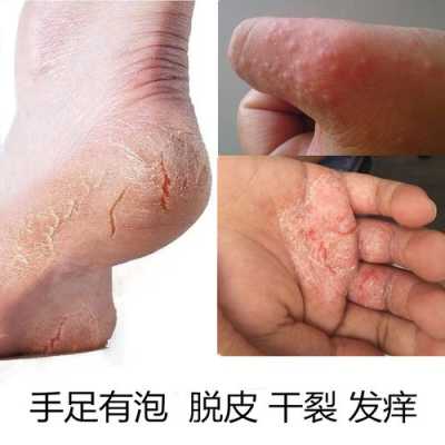 手脚皮肤粗糙怎么办（手脚皮肤粗糙怎么办图片）