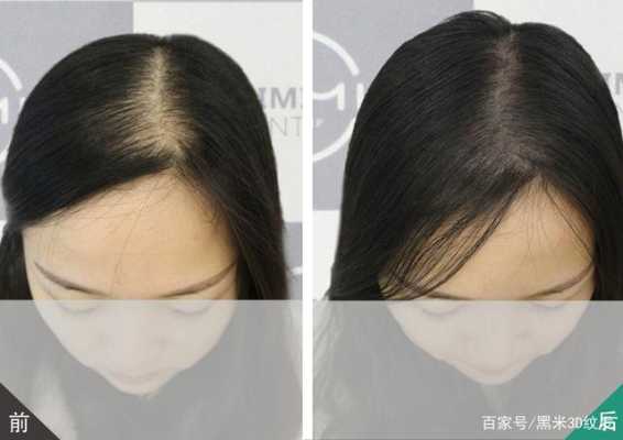 两鬓脱发怎么办（两鬓脱发怎么办女性）