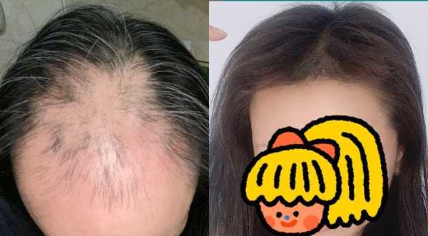 两鬓脱发怎么办（两鬓脱发怎么办女性）
