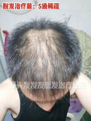 头顶头发少怎么治疗（头顶头发少怎么治疗）