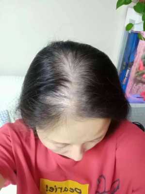 头顶上脱发怎么办（17岁女生秃顶怎么办）