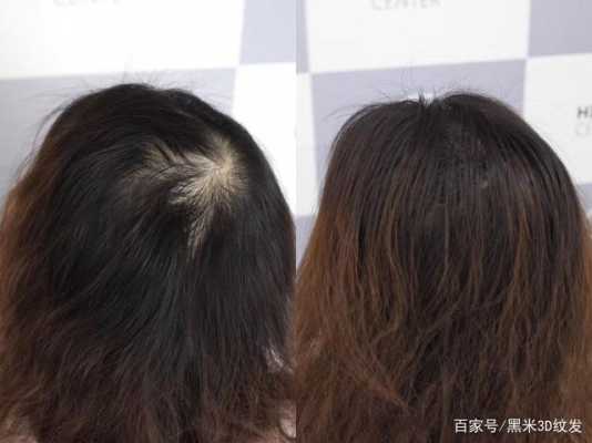 头顶上脱发怎么办（17岁女生秃顶怎么办）
