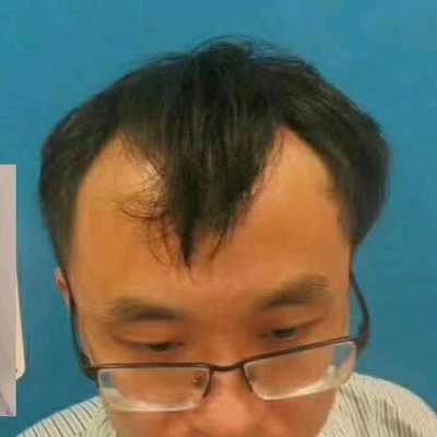 男人发际线后移怎么办（男人发际线后移是怎么回事）