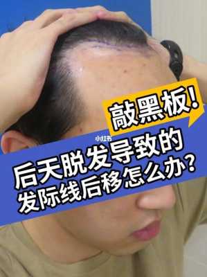 男人发际线后移怎么办（男人发际线后移是怎么回事）