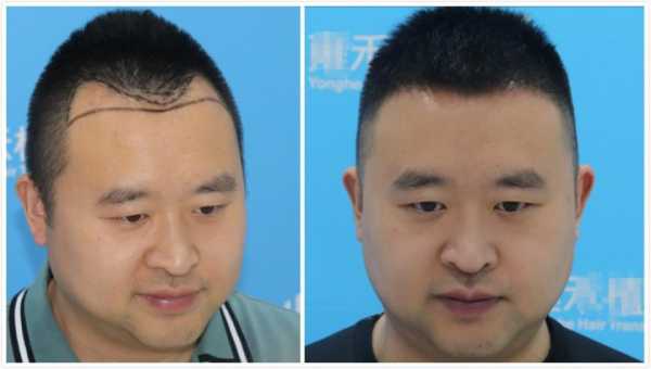男人发际线后移怎么办（男人发际线后移是怎么回事）