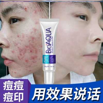 用什么东西可以去痘痘（用什么东西可以去痘痘和痘印）