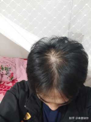 头顶的头发稀疏怎么办（头顶的头发稀疏怎么办）