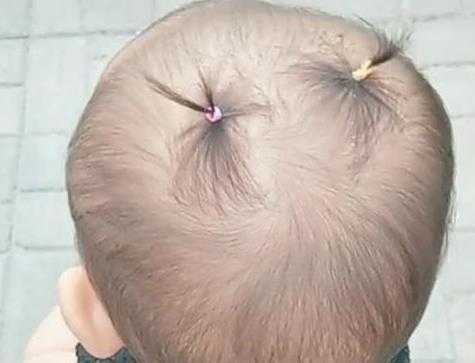小孩前额头发少怎么办（小孩前额头发少怎么办呢）