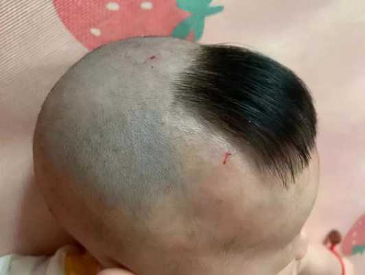 小孩前额头发少怎么办（小孩前额头发少怎么办呢）