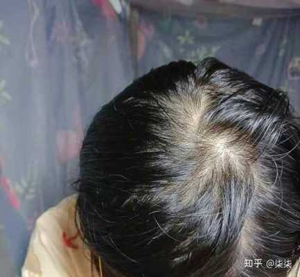 老掉头发该怎么办（老掉头发该怎么办）
