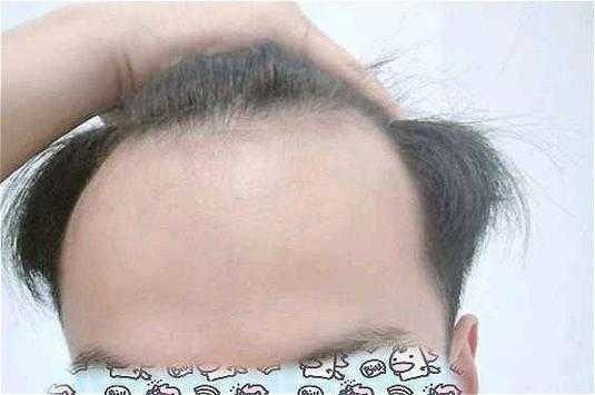 发际线高是怎么样,发际线高是什么样子