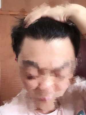 发际线高是怎么样,发际线高是什么样子