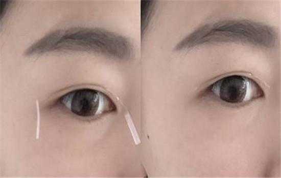 超级单眼皮怎么贴双眼皮贴,单眼皮怎么粘双眼皮的