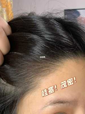 烫发后掉头发怎么办（烫完头发掉发正常吗）