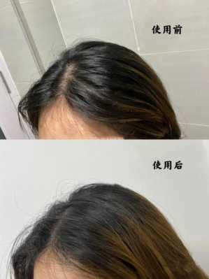 遗传性头发细软稀少怎么办（遗传性头发细软稀少怎么办）