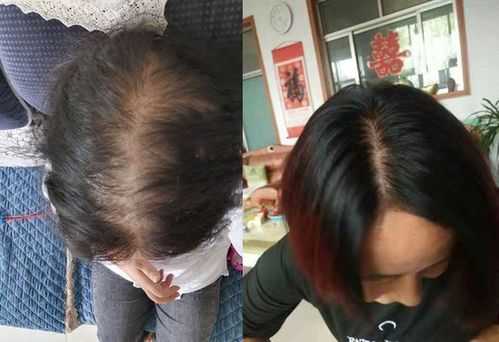 中年妇女掉头发怎么办（中年妇女掉头发怎么办）