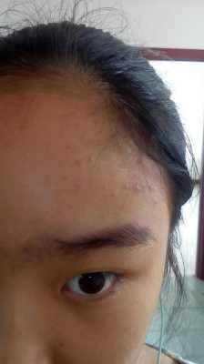 女生长了青春痘怎么办（13岁女生长青春痘怎么办）
